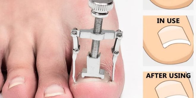 دستگاه ارتودنسی و اصلاح ناخن پا Nails